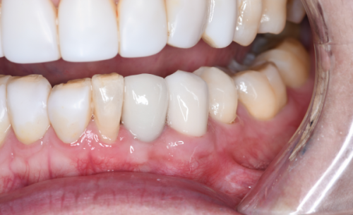 口腔护理对吃饭有啥影响