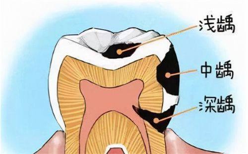 填充物材料对补牙维持时间的影响