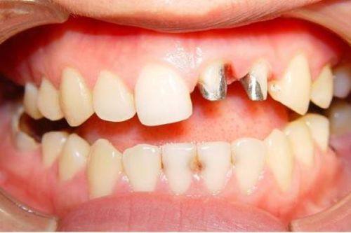 烤瓷牙对核磁共振检查结果的影响