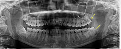 护理情况对维持时间的影响