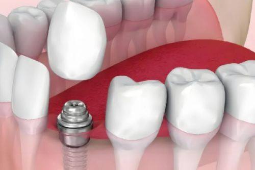骨量条件与治疗时间的关系