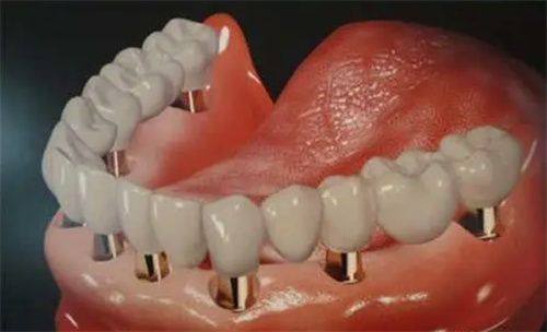 种植牙需要多长时间能取出？了解全过程与注意事项！