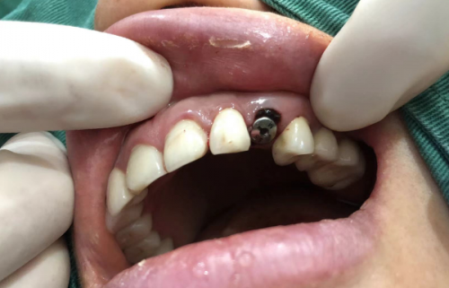 骨结合过程：等待融合