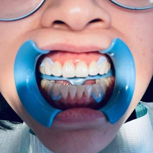 牙齿美白的成效和维持时间