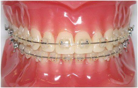 矫正难度影响费用