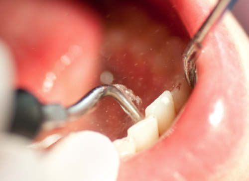 根管治疗的过程揭秘