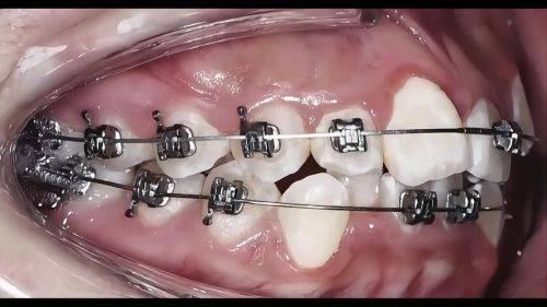 防止牙齿矫正后反弹的措施