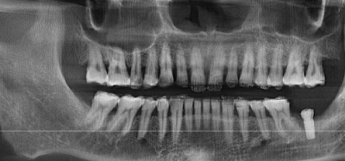 正规医院种牙价目表：2026年最新价格揭秘，你准备好了吗？