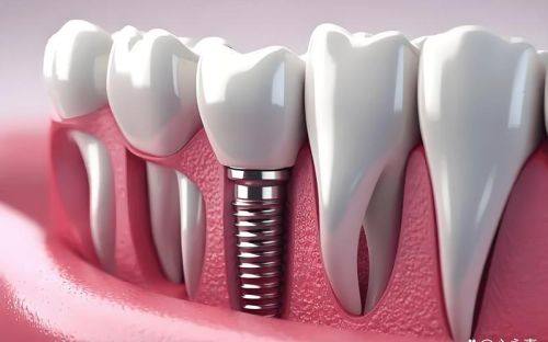 种植牙能管用多少年？揭示长期使用的秘密与维护技巧！