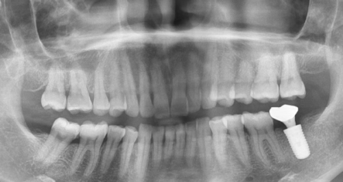 手术时长与术后修复:耐心等待“新生”