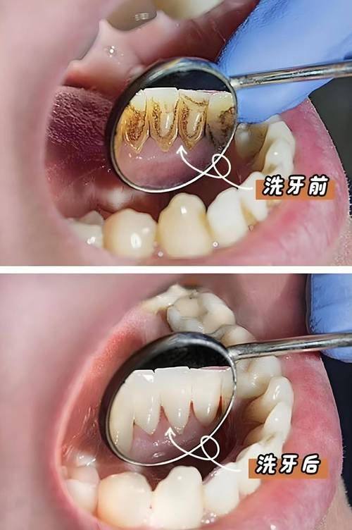 洗牙对牙齿有伤害吗？揭示真相与科学建议！
