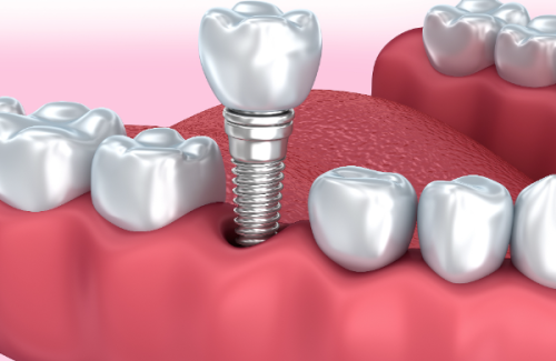 种植牙不能报销医疗保险的原因