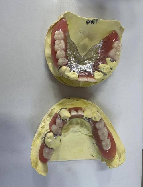 清洁与维护建议:让义齿更耐用
