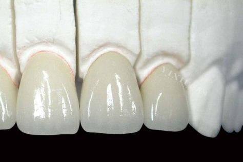 全瓷牙冠一般质保几年