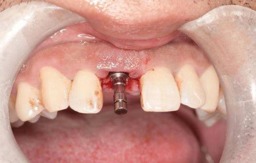 种植牙打桩后要疼几天？看症状消失的真实经历！