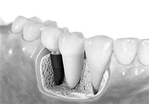 种植牙风险评估的重要性