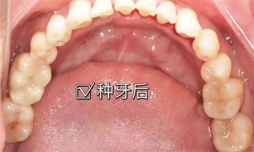 邻牙及咬合关系异常——种植牙的“阻碍”