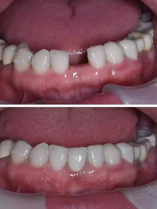 种植牙打桩后的拆线时间