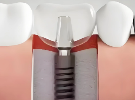 拆线过程及感受