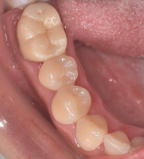 普通烤瓷牙套价格情况