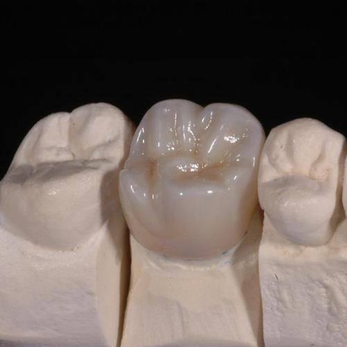 陶瓷自锁托槽牙套价格及优势