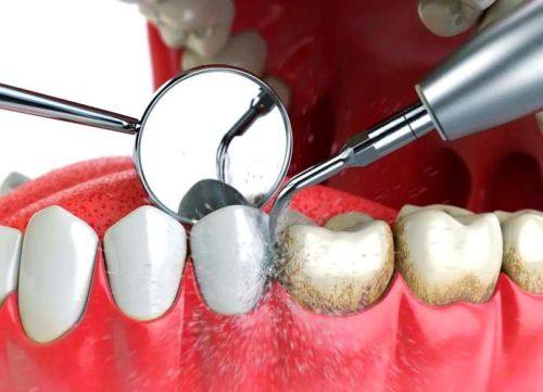 洗牙的注意事项