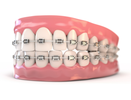牙齿矫正哪种效果好？揭秘3种热门方法的真实对比！