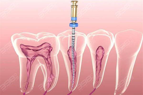 根管治疗分几个步骤？了解这5个关键步骤让你无忧！