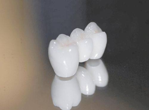 患者维护情况对全瓷牙使用寿命的影响