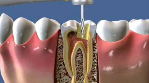 日常护理对牙齿使用寿命的作用
