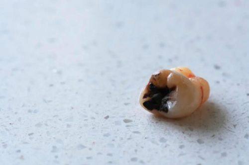 龋齿补牙后一般能维持几年？揭秘长效保养秘诀！