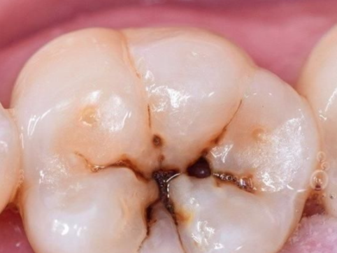 龋洞情况对填补决策的影响