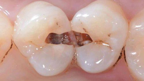 非手术治疗之窝沟封闭