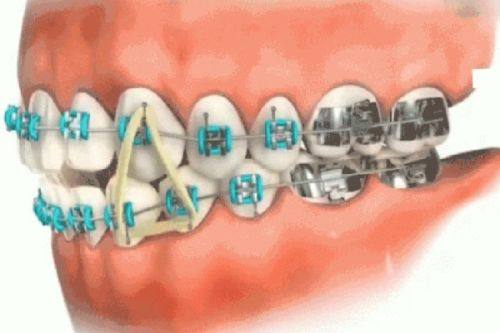 前牙反颌、偏颌畸形的至佳矫正年龄