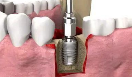 种植牙术后的疼痛与不适