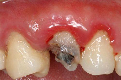 龋齿重度发展的后果