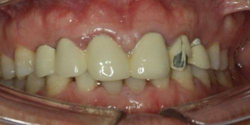 烤瓷牙日常维护建议