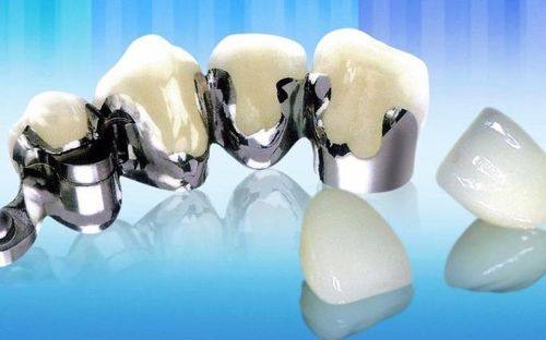 不同质量烤瓷牙套的寿命差异