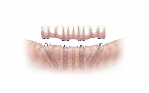 修复过程费用差异