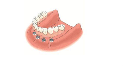 种植体类型影响价格