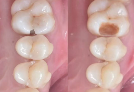 龋齿如果不治疗会怎么样？了解4大严重后果，保护你的牙齿！