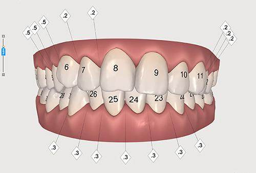 牙齿矫正有几种方法及费用？了解不同选择与价格，助你轻松美齿！