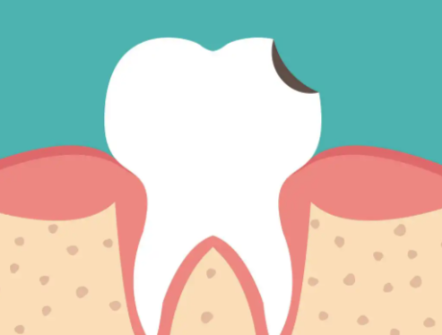 静止龋齿患者的注意事项