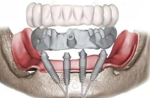 如何选择合适的种植牙方案