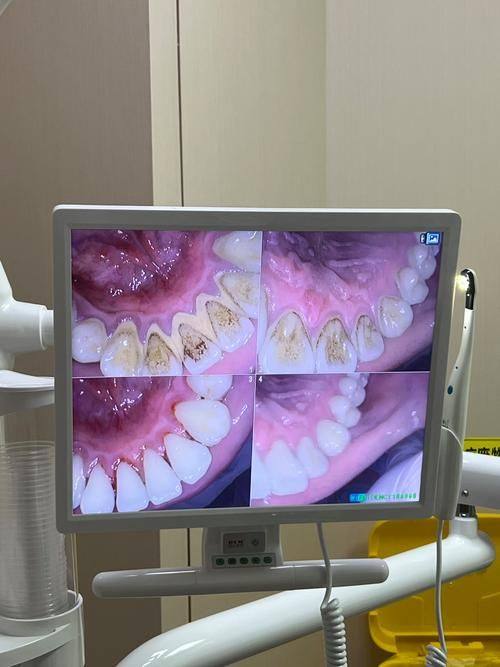 真相一：正确洗牙对牙齿无损害