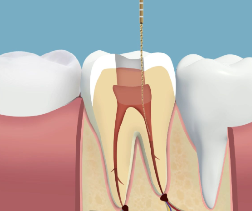 第二次治疗：疼痛不再是困扰