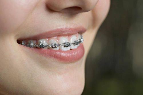 正畸牙套脱落的处理方法