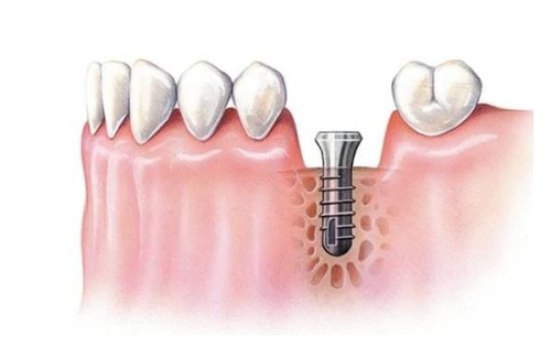 术后注意事项：促进口腔修复