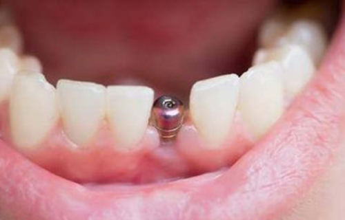 2026年种植牙医疗保险报销比例展望