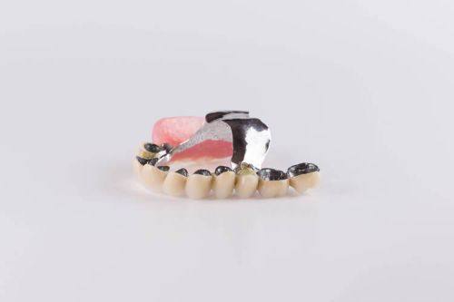 影响全瓷牙套寿命的因素